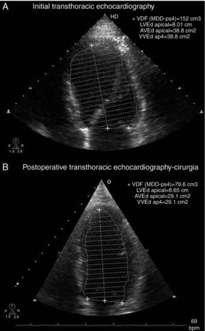 Transthoracic echocardiography in apical 4-chamber view at end-diastole, showing reduction in left ventricular end-diastolic volume: (A) before treatment; (B) two months after surgery.