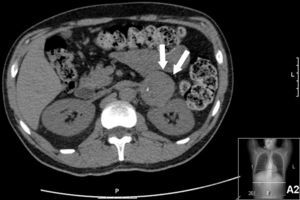 Abdominal computed tomography, showing hypodense solid mass on the left adrenal gland (arrows).
