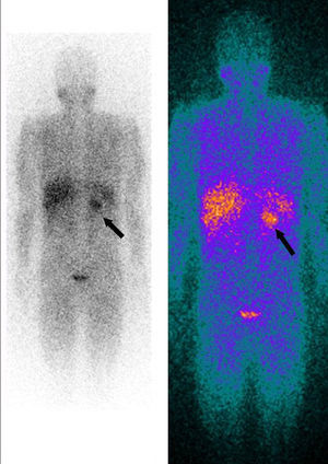Whole-body 123I-metaiodobenzylguanidine scintigraphy in posteroanterior view, showing nodular mass on the left adrenal gland (arrows).