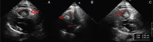 Transthoracic echocardiography 24 hours after admission showing a relatively immobile heterogeneous mass (arrow) in the right ventricle and slight pericardial effusion. (A) Mass in long-axis parasternal view; (B) mass in right ventricle in apical 4-chamber view; (C) parasternal long-axis view showing measurements of the mass. AD: right atrium; VD: right ventricle.