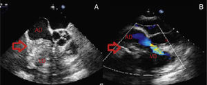 Transesophageal echocardiography to investigate the intracardiac mass (arrow). (A) Relatively immobile heterogeneous mass with both hypo- and hyperechogenic areas, adhering to the lateral wall of the right atrium and extending to the tricuspid valve, right ventricle and pericardium; (B) mass obstructing flow in the right chambers. AD: right atrium; VD: right ventricle.