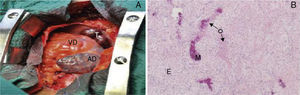 Macroscopic (A) and microscopic (B) views of the tumor. (A) Tumor (T), solid, occupying most of the right atrium; (B) histological study of the surgical specimen showing mesenchymal, epithelioid (E) and osteoid (O) proliferation, with focal mineralization (M), suggesting osteosarcoma (hematoxylin–eosin stain). AD: right atrium; VD: right ventricle.
