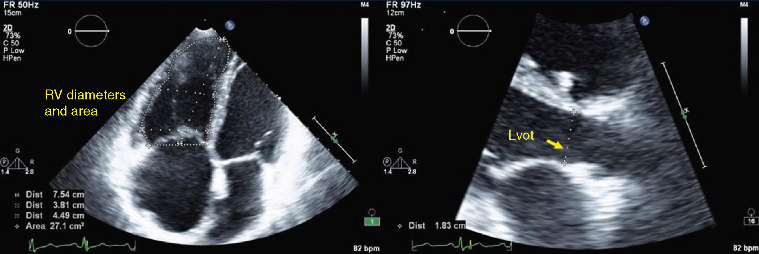 Echocardiographic assessment of right ventricular contractile reserve ...