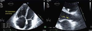 Measurements in a pulmonary hypertension patient: left – right ventricular diastolic diameters and area; right – left ventricular outflow tract diameter. <span class=