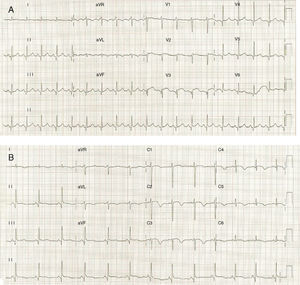 (A) ECG on admission showing ST-segment elevation in precordial leads; (B) ECG on the third day of hospitalization demonstrating T-wave inversion in precordial leads.