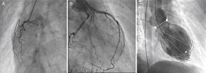 Coronary angiogram showing normal coronary arteries (A – right coronary artery, B – left coronary artery). (C) Left ventriculography: ejection fraction estimated at 27% (image obtained in systole).