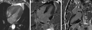 Cardiac magnetic resonance imaging. Cine true fast imaging with steady-state free precession in 4-chamber at end-systole (A) shows normal contractility of the left ventricular apex with complete resolution of apical ballooning; 4-chamber (B) and 2-chamber (C) delayed post-contrast imaging shows no abnormal myocardial enhancement.