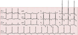 ECG showing sinus rhythm (66 bpm), increased QRS voltage and diffuse, deep, symmetric T-wave inversion.
