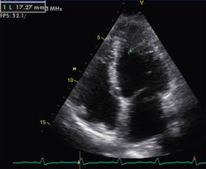 Transthoracic echocardiogram showing apical left ventricular hypertrophy.