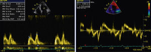 Transthoracic echocardiogram showing left ventricular diastolic dysfunction (impaired relaxation).