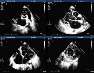 Transthoracic echocardiography. LA: left atrium, LV: left ventricle, SMA: submitral aneurysm, SVA: sinus of Valsalva aneurysm.