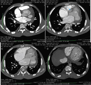 Multislice computed tomography. LA: left atrium, LV: left ventricle, SMA: submitral aneurysm, SVA: sinus of Valsalva aneurysm.