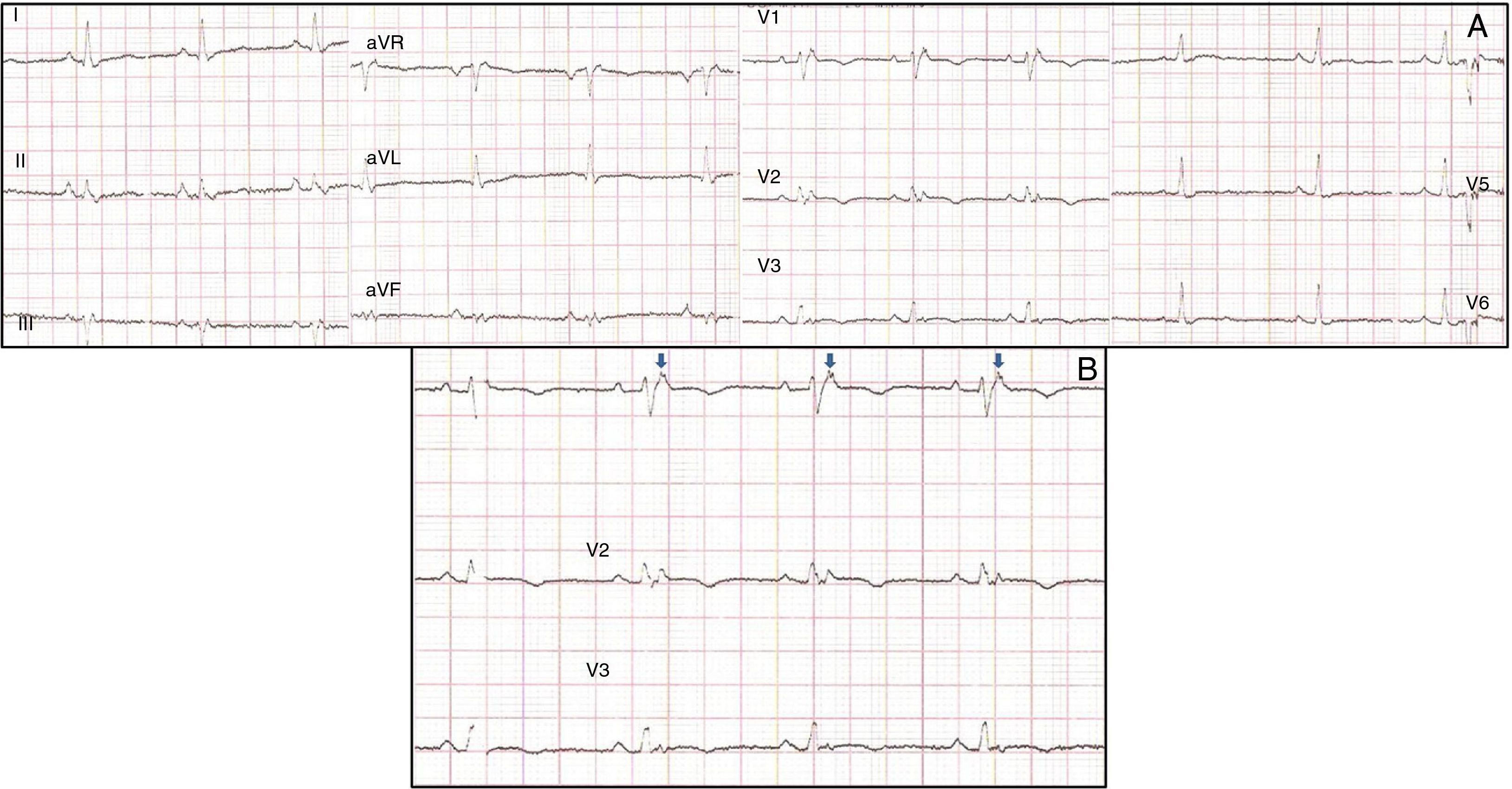 Arrhythmogenic right ventricular cardiomyopathy: Contribution of ...
