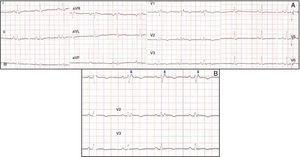 (A) Standard 12-lead ECG; (B) detail of leads V1 to V3. Arrows indicate epsilon waves.