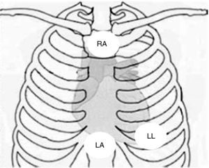 Placement of electrodes in Fontaine ECG. LA: left arm electrode; LL: left leg electrode; RA: right arm electrode.