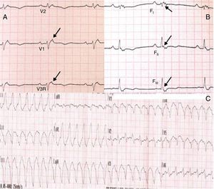 Epsilon waves in some leads (arrows): (A) in right precordial leads; (B) in modified Fontaine leads. (C) Ventricular tachycardia with left bundle branch block morphology and superior axis.