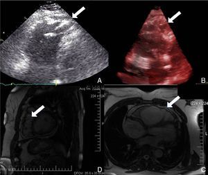 Alterations documented by imaging studies: (A) two-dimensional transthoracic echocardiogram; (B) three-dimensional transthoracic echocardiogram; (C) and (D) cardiac magnetic resonance. Arrows indicate saccular dilatations in the right ventricular free wall.