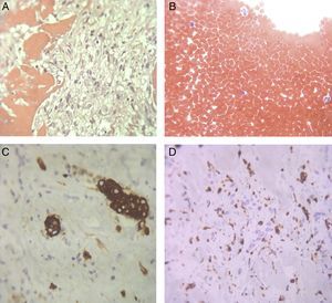 Histological samples. (A) Fibrinous pericarditis (hematoxylin-eosin ×100); (B) bloody pericardial effusion, with no signs of malignity (hematoxylin-eosin ×100); (C) hyperplastic mesothelial cells (calretinin ×100); (D) inflammatory infiltrate with numerous macrophages (CD68 ×100).