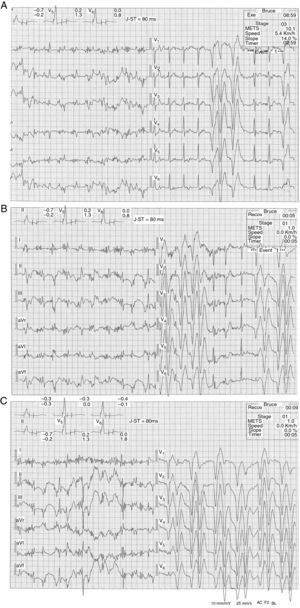 Electrocardiographic traces, at peak exercise 8.59 min into test (A), at 5 s into recovery (B), and at 9 s into recovery (C).