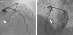 Selective angiography of the left coronary artery (A: 10° right anterior oblique, 40° cranial view; B: 45° left anterior oblique, 25° cranial view), showing part of the distal segment of the right coronary and posterior descending arteries via an intercoronary connection with the circumflex artery at the level of the crux (arrow).
