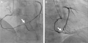Right coronary angiography (A: 20° left anterior oblique, 20° cranial view; B: 30° right anterior oblique view), showing connection between the right coronary and the circumflex arteries (arrow). (A) suggests the presence of coronary arcade and (B) shows the atrioventricular groove, with the atria to the left and the ventricles to the right.
