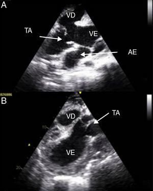 Large common vessel exiting both ventricles. (A) Subcostal view and (B) parasternal long-axis view. AE: left atrium; TA: truncus arteriosus; VD: right ventricle; VE: left ventricle.