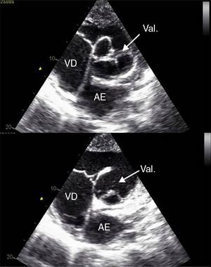 Single tricuspid valve by the left ventricular outflow tract and the left atrium, in parasternal short-axis view. AE: left atrium; Val.: valve; VD: right ventricle.