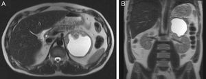 Abdominal magnetic resonance imaging: T2‐weighted transverse (A) and coronal (B) views showing a nodular formation on the left adrenal gland with major axis diameter of 9.8 cm, predominantly cystic, with thickened irregular walls and a solid component in the anterior, medial and inferior portions (maximum thickness 4 cm), with heterogeneous late enhancement after contrast administration and diffusion restriction.