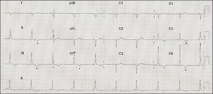 ECG showing sinus rhythm at 71 bpm, PR interval 120 ms, right axis deviation, poor R‐wave progression in the precordial leads, inferolateral repolarization abnormalities and negative T wave in V5‐V6, II, III and aVF (asterisk).