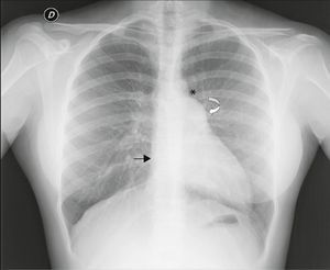 Posterior–anterior chest X‐ray showing levoposition of the heart without tracheal deviation, right heart border superimposed on the spine (straight arrow), imprint of the main pulmonary artery (curved arrow), interposition of lung parenchyma between the aortic arch and left pulmonary artery (asterisk) and flattening and elongation of the left ventricular contour (Snoopy sign).