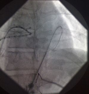 Insertion of guidewire in the pericardial space following subxiphoid puncture.