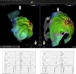 Images from CARTO mapping system: endocardial mapping (top left) and epicardial mapping (top right). Endocardial electrogram (bottom left) and epicardial electrogram (bottom right) showing earlier epicardial signal (62 ms vs. 80 ms).