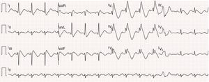 12-Lead electrocardiogram showing bifascicular block (complete right bundle branch block and left anterior hemiblock), type 1 Brugada pattern (with coved ST elevation in V1–V4, terminating in inverted T wave), long QT interval (522 ms, corrected QT 568 ms) and isolated ventricular extrasystole with left bundle branch block morphology and inferior axis.