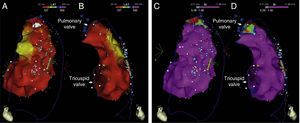 Endocardial maps of the right ventricle. Mapping of time to end of local bipolar electrogram in anteroposterior view (A) and right lateral view (B): activation of the endocardial regions ends during the surface QRS (in red), which ended 127 ms after the map reference. Mapping of bipolar voltage in anteroposterior view (C) and right lateral view (D): all endocardial regions of the right ventricle show normal voltage (>1.5 mV) (in pink).