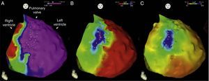 Epicardial maps in anteroposterior views: (A) mapping of bipolar voltage, showing normal voltage (>1.5 mV, in pink) in all epicardial regions of the left ventricle and right ventricular outflow tract (regions with lower voltage correspond to pulmonary and tricuspid valve planes; voltage in the epicardial apical region was not assessed); (B) mapping of time to end of the local bipolar electrogram; and (C) mapping of the duration of the local bipolar electrogram. The electrograms recorded in the left ventricle were of normal duration and ended during the surface QRS. An area measuring 6.9 cm2 was identified in the anterior region of the right ventricular outflow tract with fractionated potentials (light pink dots), of long duration (up to 370 ms) and lasting up to 216 ms after the end of the QRS.