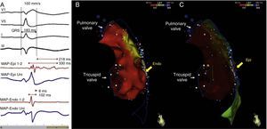 Endo-epicardial dispersion of action potential duration in the anterior region of the right ventricular outflow tract: (A) bipolar and unipolar electrograms of the epicardium (MAP-Epi) and endocardium (MAP-Endo) recorded in contiguous sites, shown in right profile views on the endocardial (B) and epicardial (C) maps of the right ventricle. The marked prolongation of epicardial depolarization (duration 330 ms, lasting up to 216 ms after the end of the QRS) contrasts with the normal duration of depolarization in the corresponding endocardial region (102 ms).