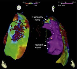 Radiofrequency energy applications on the epicardial side of the anterior region of the right ventricular outflow tract, covering the area with prolonged action potentials.
