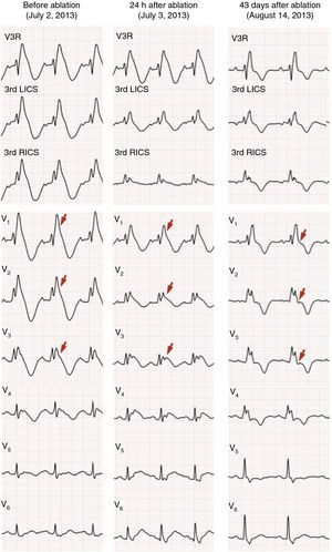 Comparison of surface electrocardiograms before and after ablation. LICS: left intercostal space; RICS: right intercostal space.