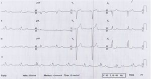 Electrocardiogram showing 2:1 atrioventricular block.