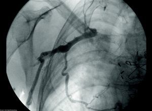 Venography showing total occlusion of the right subclavian vein and collateral circulation.