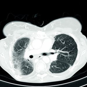 High-resolution chest computed tomography showing diffuse thoracic fibrosis and mediastinal deviation.