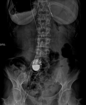 Abdominal-pelvic X-ray. DTO: right.