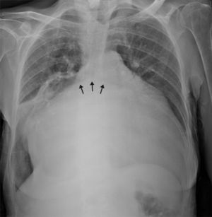 Chest X-ray, posteroanterior view, showing marked cardiomegaly (cardiothoracic ratio 0.92) and splaying of the carina (arrows).