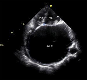 Transthoracic echocardiogram, apical 4-chamber view, showing giant left atrium distorting the geometry of the other chambers. AD: right atrium; AEG: giant left atrium; VD: right ventricle; VE: left ventricle.