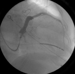 Angiogram of the coronary sinus, showing sparse venous system.
