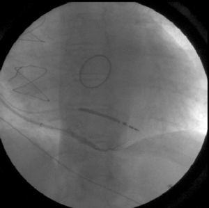 Angiogram of the posterior vein.