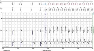 Onset of episode of ventricular tachycardia recorded by the Home Monitoring system (Biotronik®).