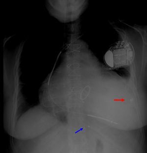 Chest X-ray, anteroposterior view, showing pacing lead in the posterior vein (blue arrow) and epicardial lead in lateral position (red arrow).