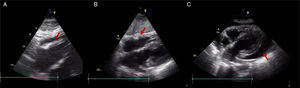 Echocardiographic subcostal views: (A) after permanent pacemaker implantation revealing a new moderate pericardial effusion (arrow); (B) at hospital discharge, after a few days of clinical surveillance with no evidence of pericardial effusion (arrow); and (C) at readmission, with a large pericardial effusion and ‘swinging heart’ (arrow).