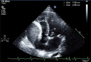 Transthoracic echocardiography, apical 4-chamber view, showing a homogeneous mass compressing the right atrium.